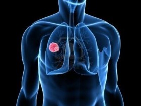 Advanced Non-Small Cell Lung Cancer