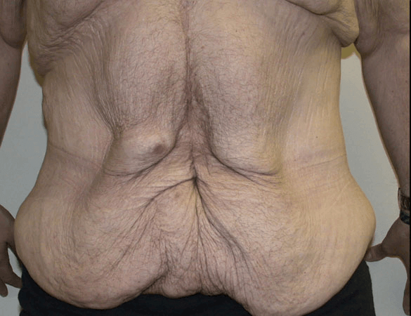 Sagging Skin After Gastric Band Surgery